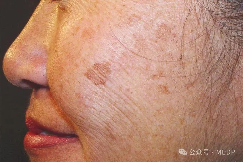 老年斑、晒斑、日光性雀斑是一回事吗？
